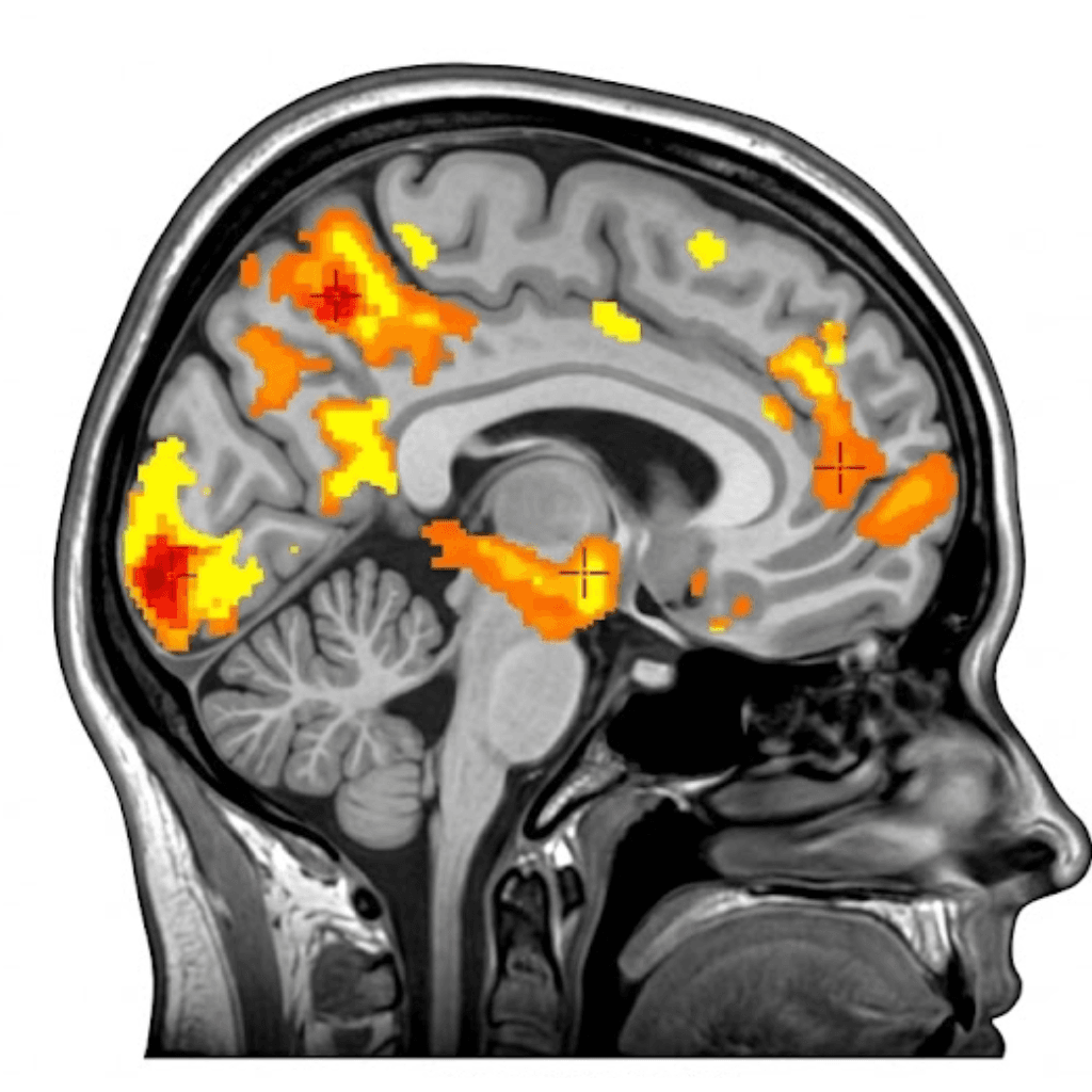 Real fMRI activation scan used to train the fusion model